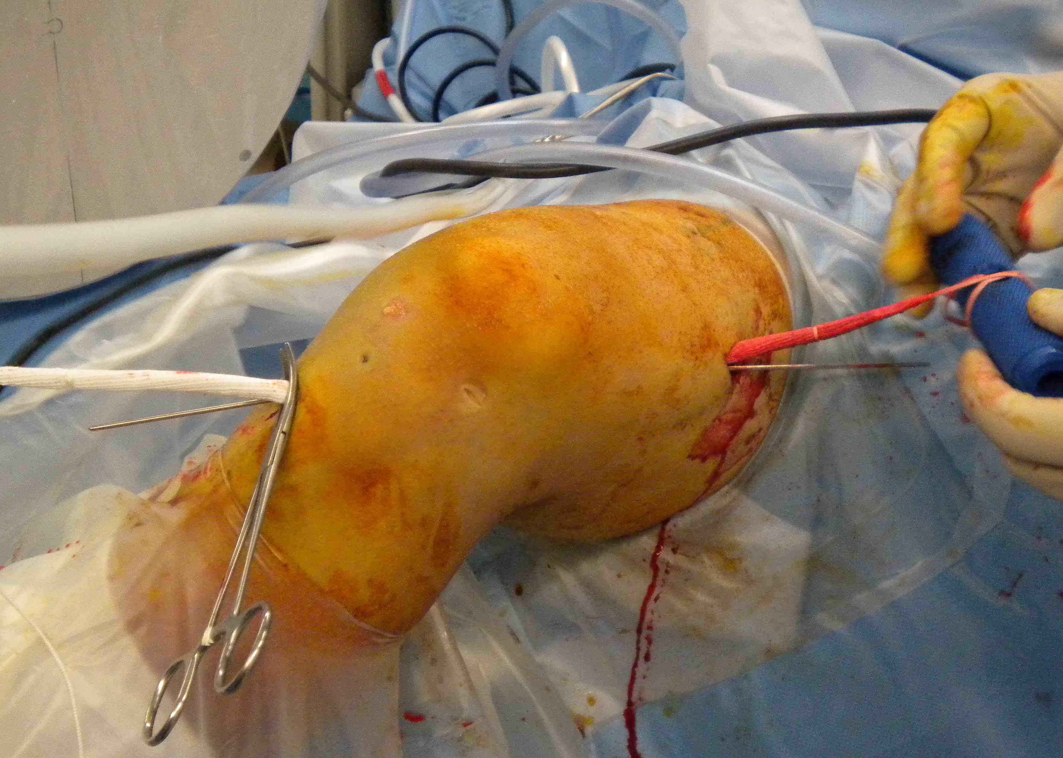 Lars ACL Pass Graft 3